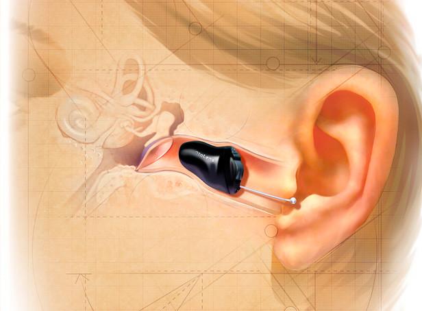 Invisible Hearing Aids (IIC)